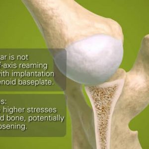 Exactech Equinoxe Baseplates for Posterior Wear in Reverse Shoulder Arthroplasty - 718-00-03