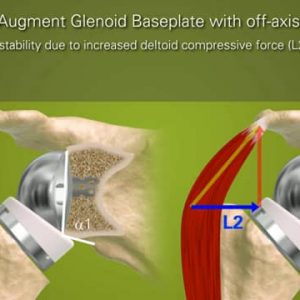 Exactech Equinoxe Baseplates for Superior Wear in Total Shoulder Arthroplasty - 718-00-04