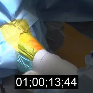 Exactech: ExactechGPS TKA Surgery with Real-Time Guide - 12-0000505