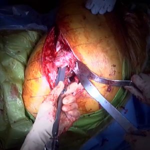 Exactech Alteon Monobloc Revision Hip Stem Testimonial Dr. Kang